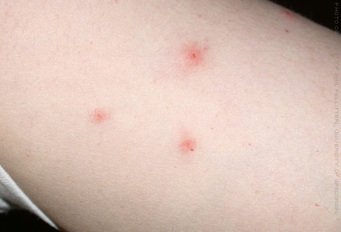 PHOTOS OF BED BUG BITES