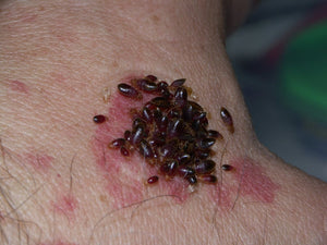 Woman Killed by Bed Bug Bites? - ZappBug