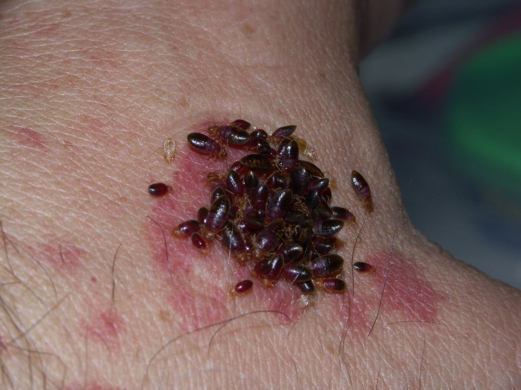 Woman Killed by Bed Bug Bites?